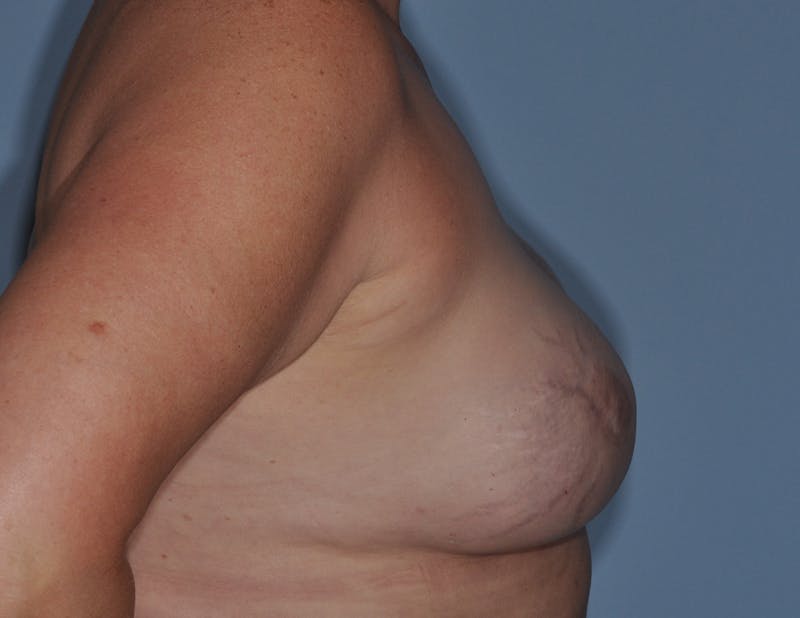 Breast Reconstruction Before & After Gallery - Patient 186162 - Image 6