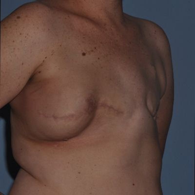 Breast Reconstruction Before & After Gallery - Patient 873748 - Image 5