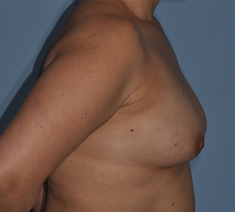 Breast Fat Transfer Before & After Gallery - Patient 329293 - Image 3