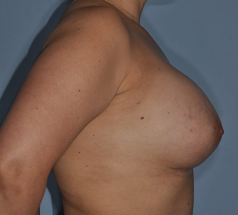 Breast Fat Transfer Before & After Gallery - Patient 329293 - Image 4