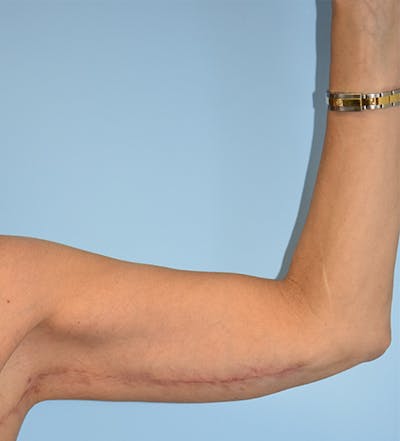Brachioplasty Before & After Gallery - Patient 293637 - Image 2