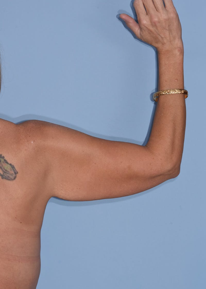 Brachioplasty Before & After Gallery - Patient 293637 - Image 3