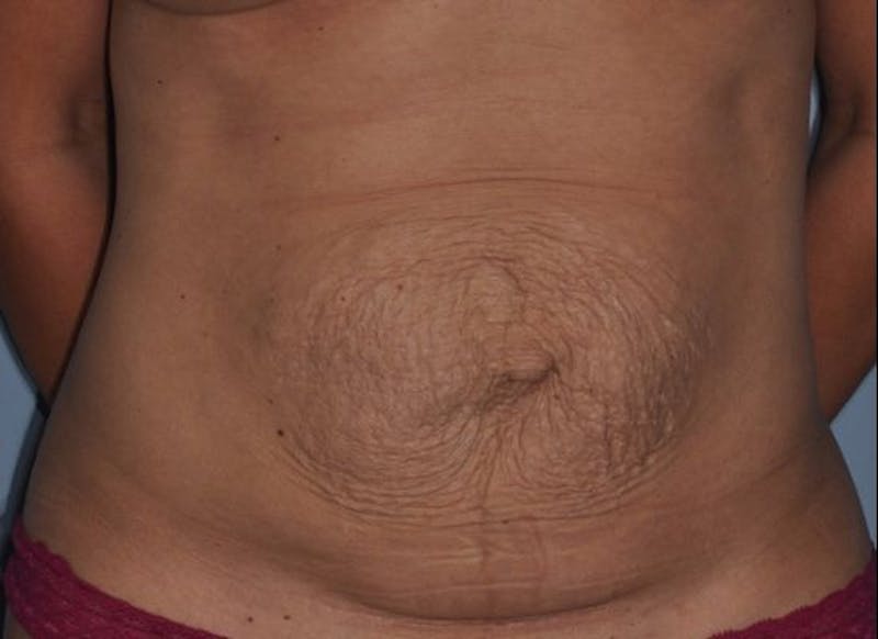 Tummy Tuck (Abdominoplasty) Before & After Gallery - Patient 429459 - Image 1