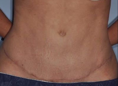 Tummy Tuck (Abdominoplasty) Before & After Gallery - Patient 429459 - Image 2