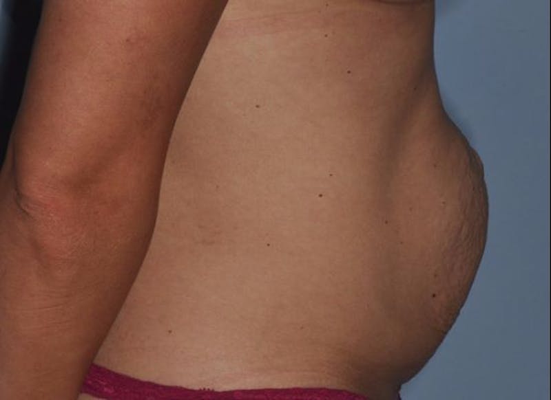 Tummy Tuck (Abdominoplasty) Before & After Gallery - Patient 429459 - Image 3