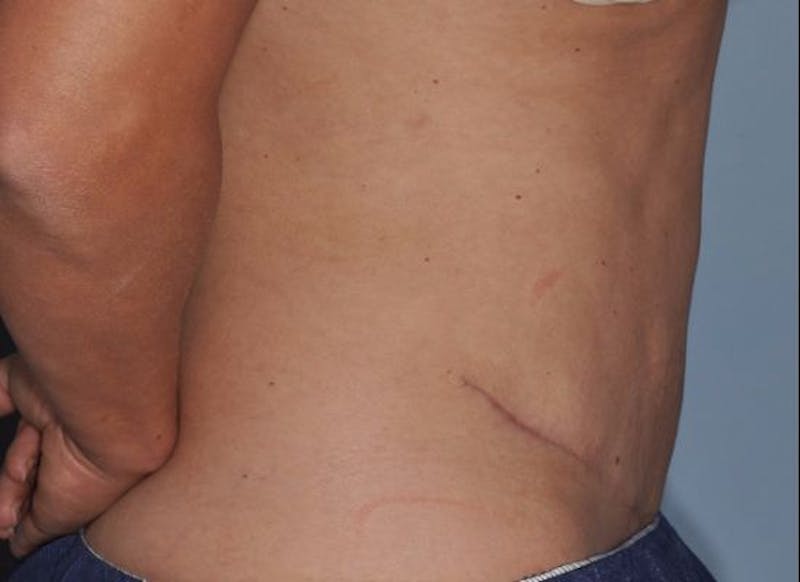 Tummy Tuck (Abdominoplasty) Before & After Gallery - Patient 429459 - Image 4