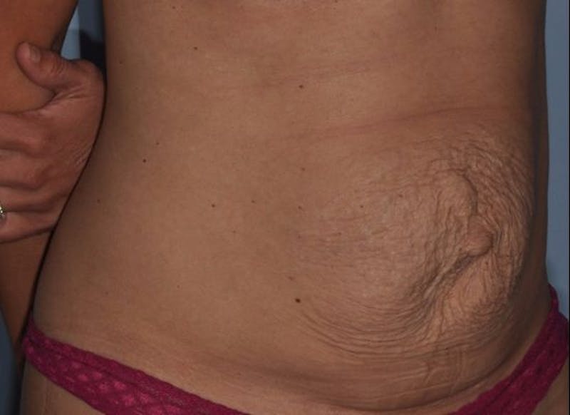 Tummy Tuck (Abdominoplasty) Before & After Gallery - Patient 429459 - Image 5