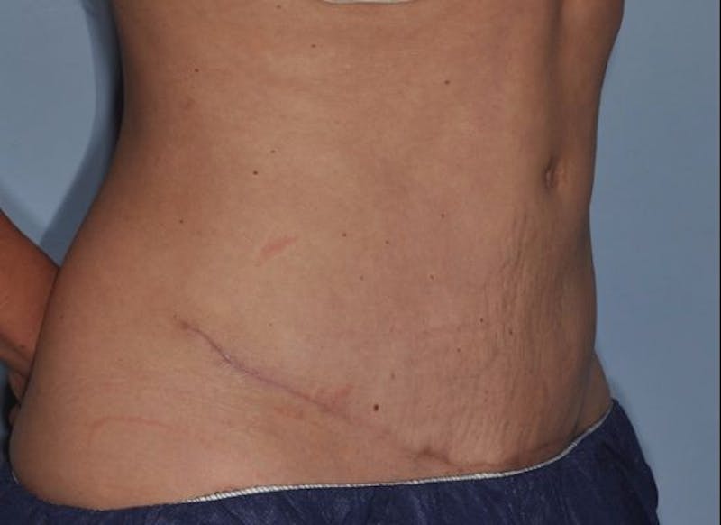 Tummy Tuck (Abdominoplasty) Before & After Gallery - Patient 429459 - Image 6
