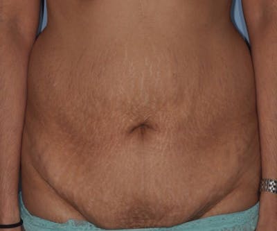 Tummy Tuck (Abdominoplasty) Before & After Gallery - Patient 166674 - Image 1