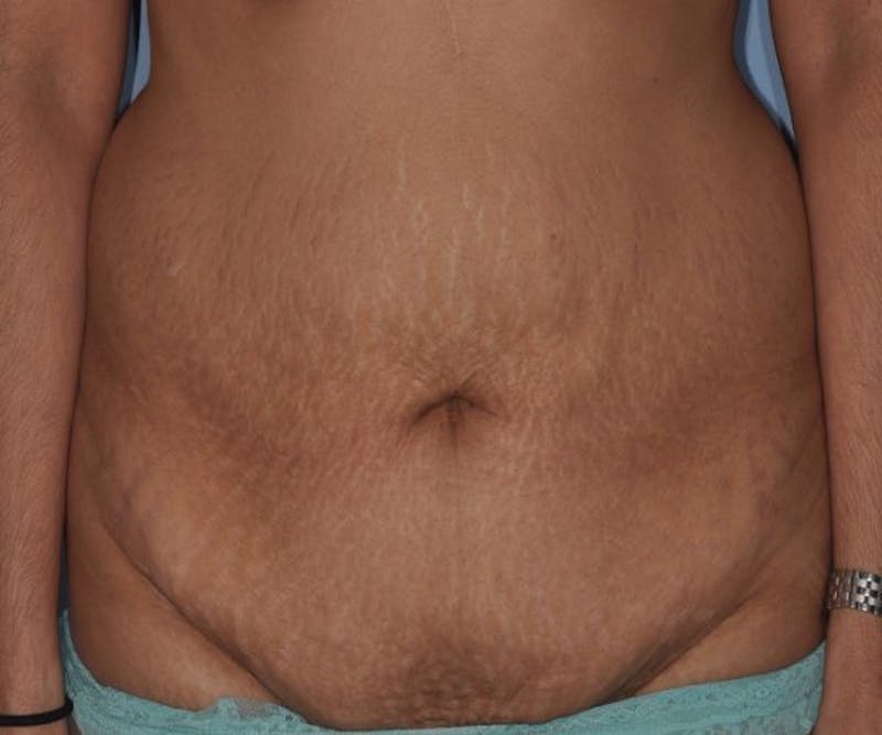 Tummy Tuck (Abdominoplasty) Before & After Gallery - Patient 166674 - Image 1
