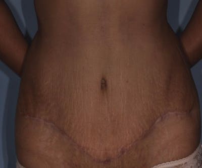 Tummy Tuck (Abdominoplasty) Before & After Gallery - Patient 166674 - Image 2