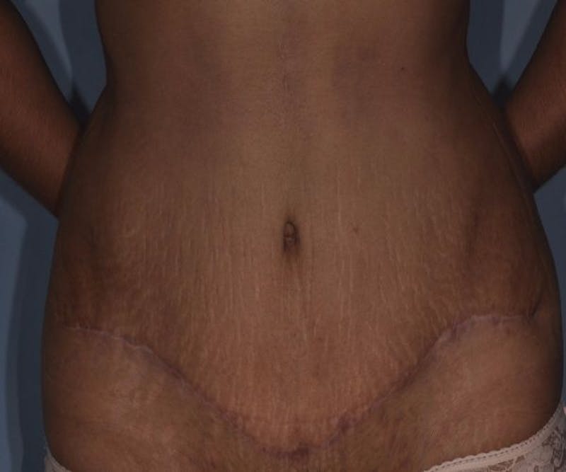 Tummy Tuck (Abdominoplasty) Before & After Gallery - Patient 166674 - Image 2