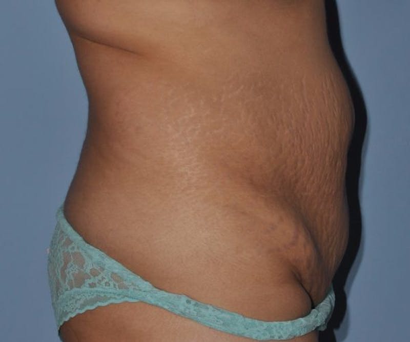 Tummy Tuck (Abdominoplasty) Before & After Gallery - Patient 166674 - Image 3