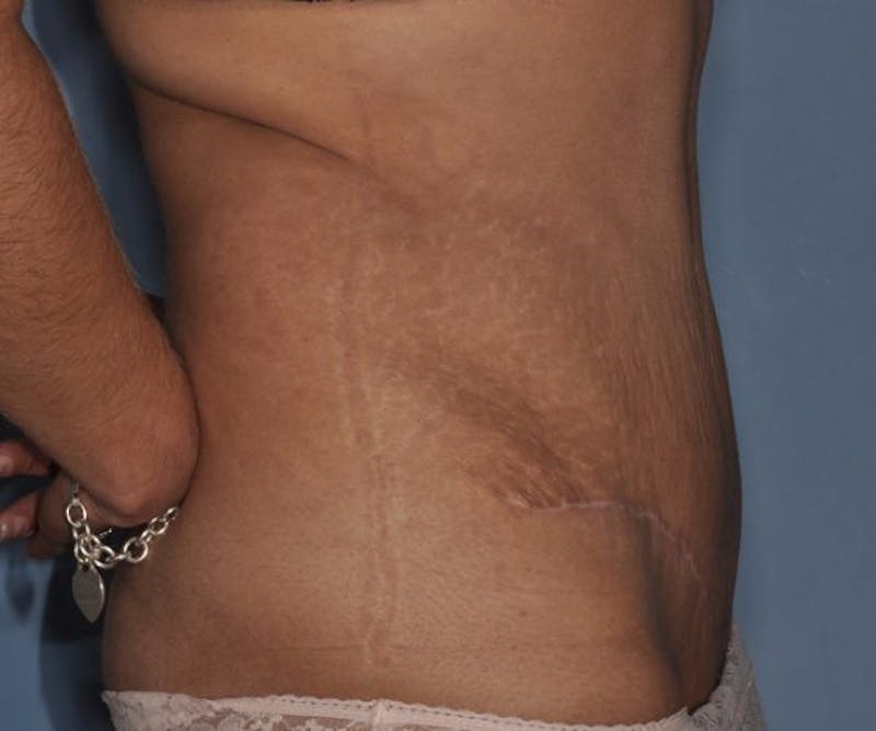 Tummy Tuck (Abdominoplasty) Before & After Gallery - Patient 166674 - Image 4