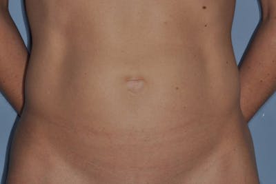 Tummy Tuck (Abdominoplasty) Before & After Gallery - Patient 375027 - Image 1