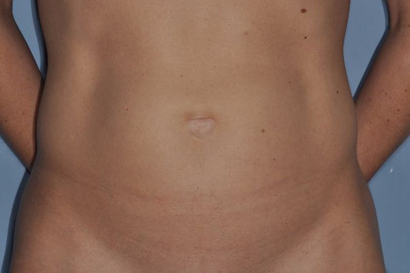 Tummy Tuck (Abdominoplasty) Before & After Gallery - Patient 375027 - Image 1