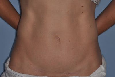 Tummy Tuck (Abdominoplasty) Before & After Gallery - Patient 375027 - Image 2