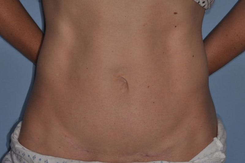 Tummy Tuck (Abdominoplasty) Before & After Gallery - Patient 375027 - Image 2