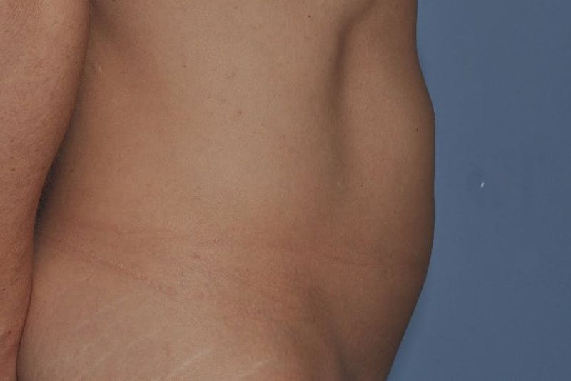 Tummy Tuck (Abdominoplasty) Before & After Gallery - Patient 375027 - Image 3