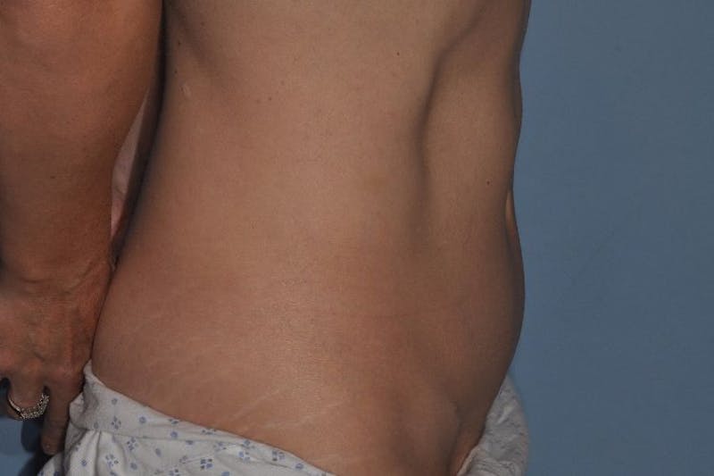 Tummy Tuck (Abdominoplasty) Before & After Gallery - Patient 375027 - Image 4