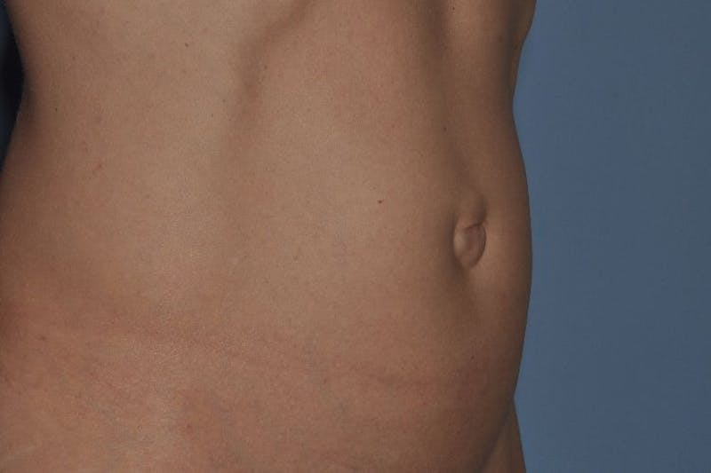 Tummy Tuck (Abdominoplasty) Before & After Gallery - Patient 375027 - Image 5