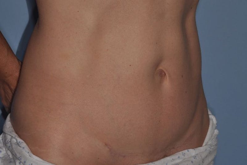 Tummy Tuck (Abdominoplasty) Before & After Gallery - Patient 375027 - Image 6