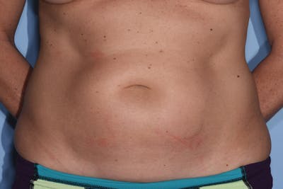 Liposuction Before & After Gallery - Patient 412803 - Image 1