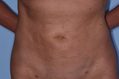Liposuction Before & After Gallery - Patient 412803 - Image 2