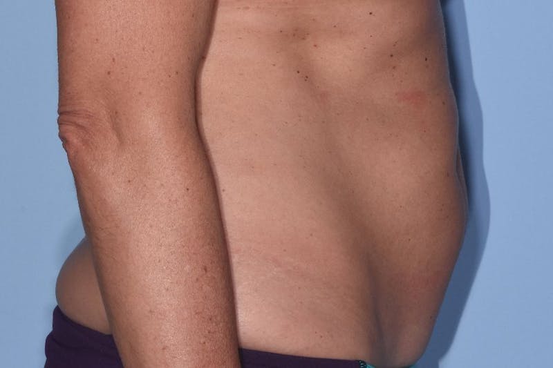 Liposuction Before & After Gallery - Patient 412803 - Image 3