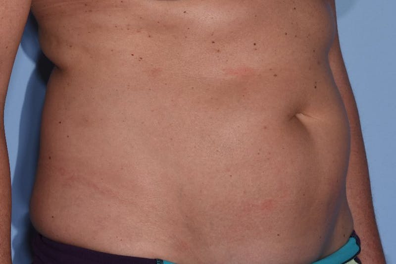 Liposuction Before & After Gallery - Patient 412803 - Image 5