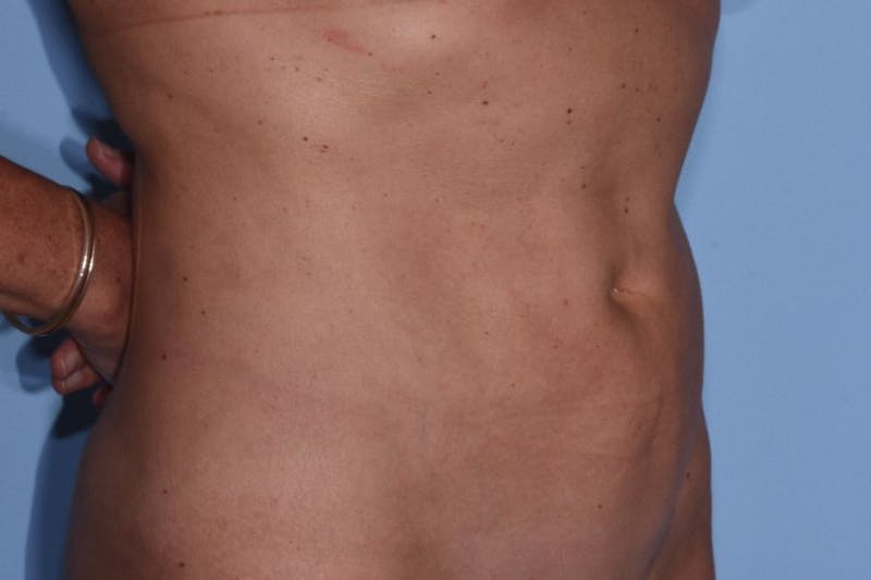Liposuction Before & After Gallery - Patient 412803 - Image 6