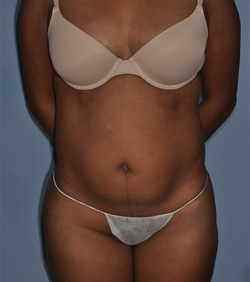 Buttock Augmentation Before & After Gallery - Patient 404977 - Image 1