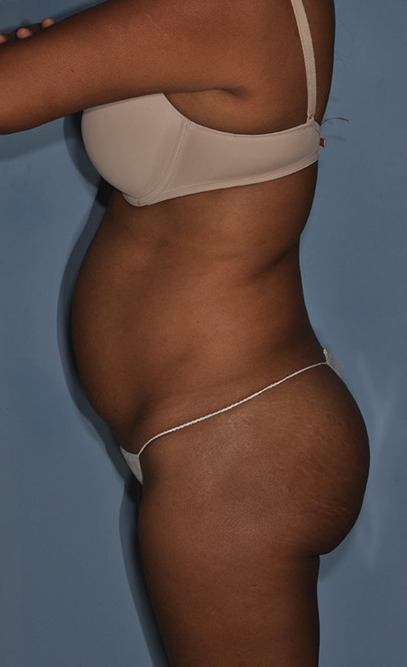 Buttock Augmentation Before & After Gallery - Patient 404977 - Image 5