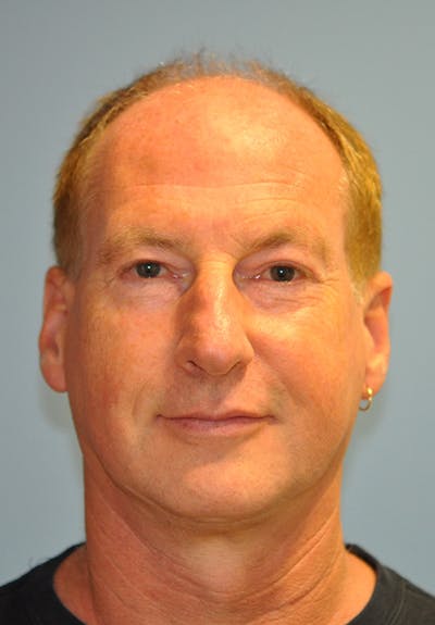 Facelift Before & After Gallery - Patient 473517 - Image 1