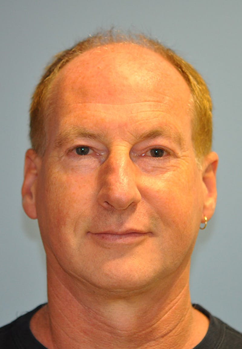 Facelift Before & After Gallery - Patient 473517 - Image 1