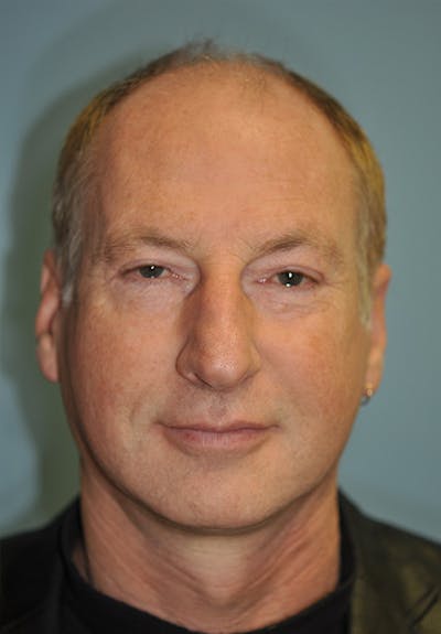 Facelift Before & After Gallery - Patient 473517 - Image 2