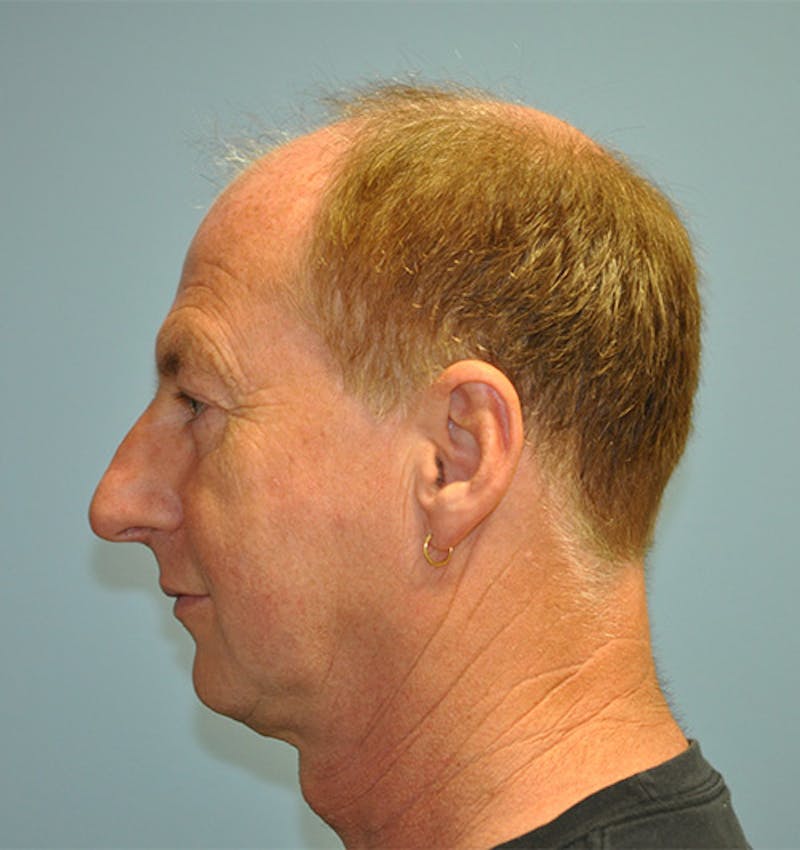 Facelift Before & After Gallery - Patient 473517 - Image 3
