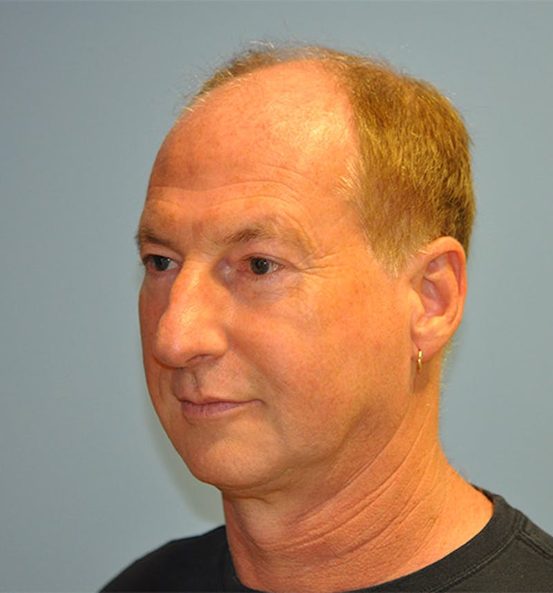 Facelift Before & After Gallery - Patient 473517 - Image 5