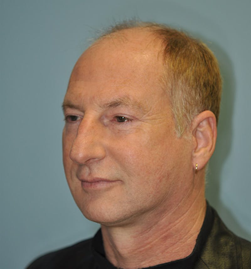 Facelift Before & After Gallery - Patient 473517 - Image 6