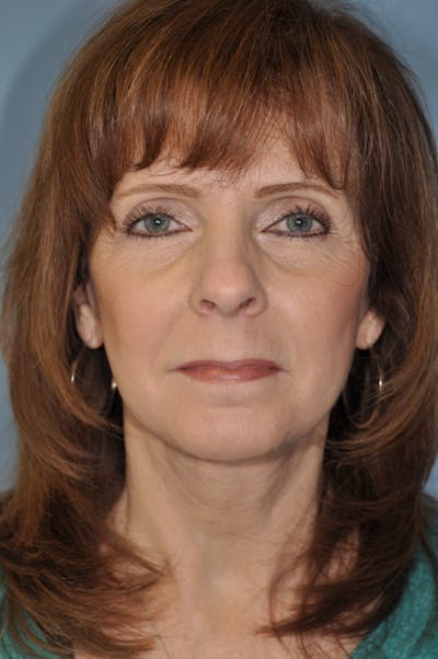 Facelift/Necklift Before & After Gallery - Patient 172737 - Image 2