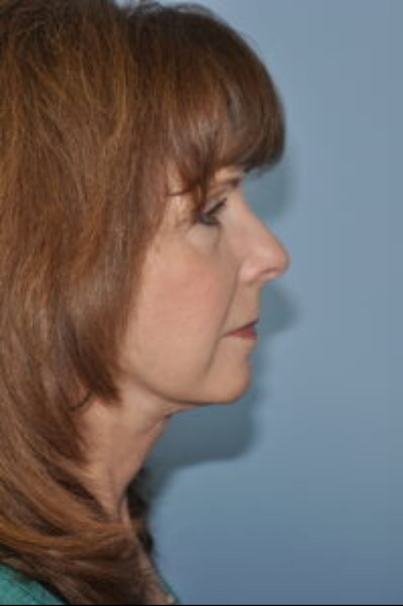 Facelift/Necklift Before & After Gallery - Patient 172737 - Image 4