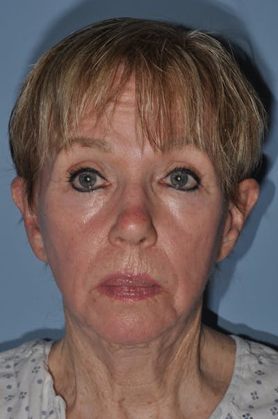 Facelift/Necklift Before & After Gallery - Patient 252755 - Image 1