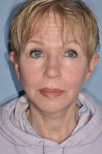 Facelift/Necklift Before & After Gallery - Patient 252755 - Image 2