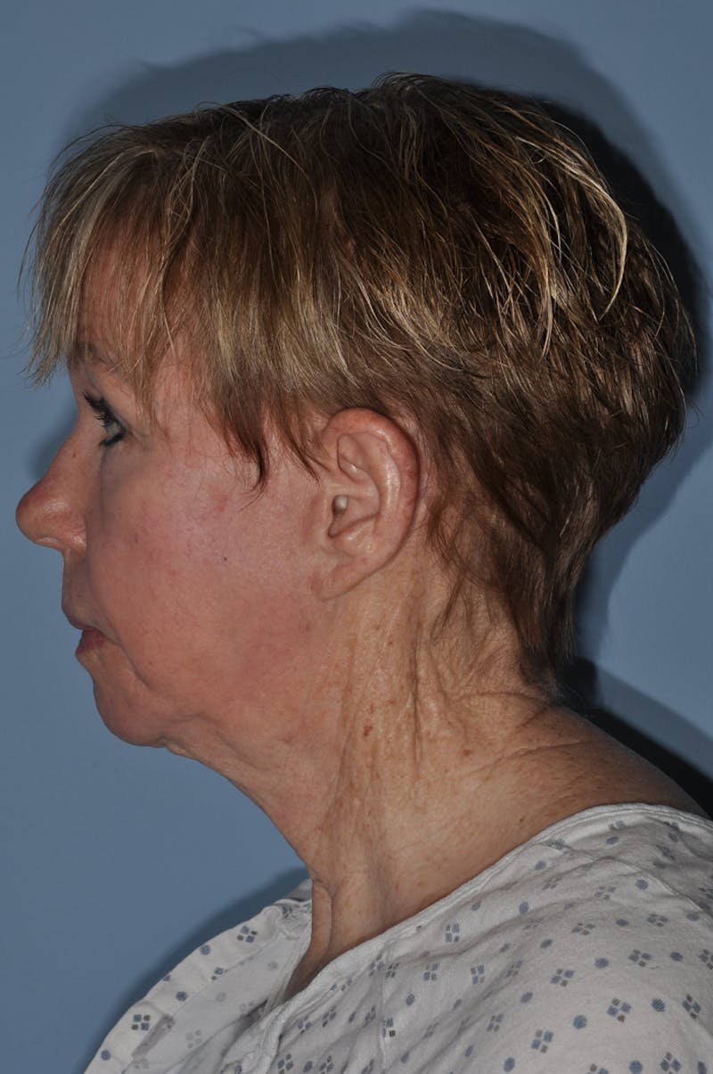 Facelift/Necklift Before & After Gallery - Patient 252755 - Image 3
