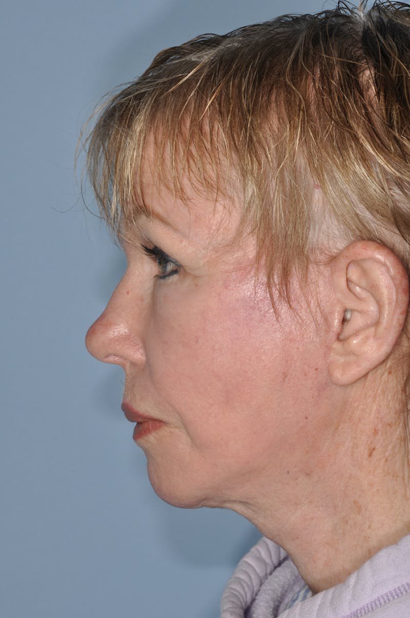 Facelift/Necklift Before & After Gallery - Patient 252755 - Image 4