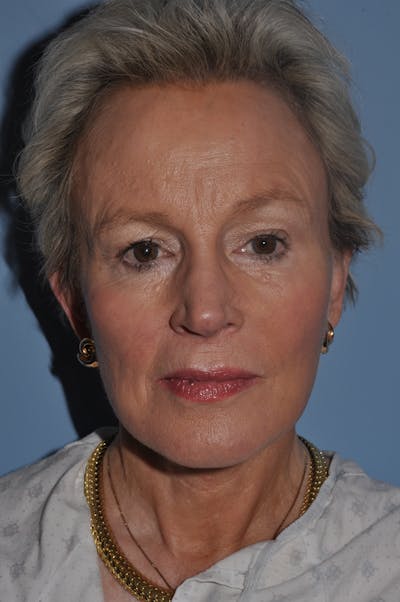 Facelift/Necklift Before & After Gallery - Patient 885235 - Image 1