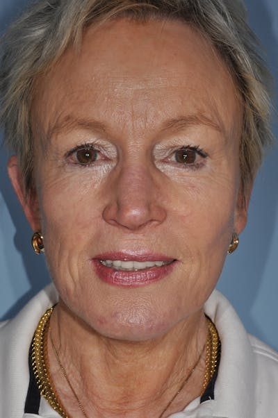 Facelift/Necklift Before & After Gallery - Patient 885235 - Image 2