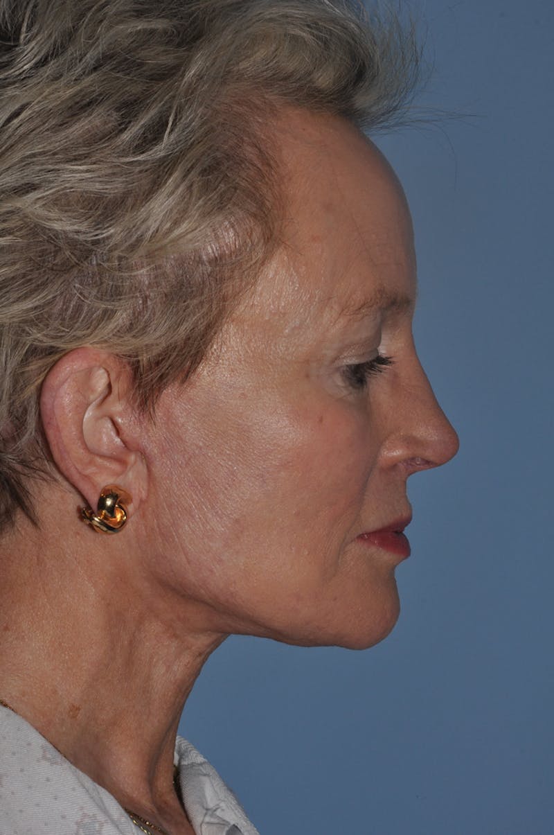 Facelift/Necklift Before & After Gallery - Patient 885235 - Image 3