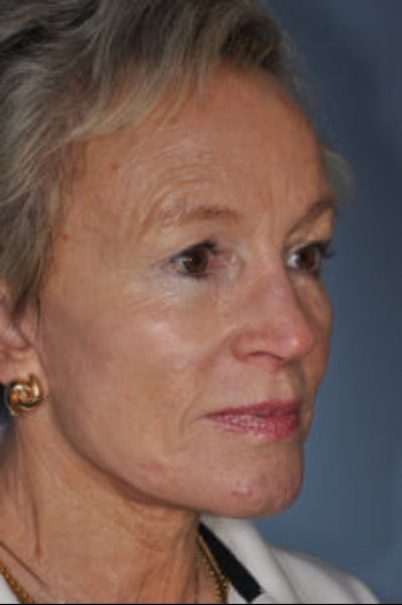 Facelift/Necklift Before & After Gallery - Patient 885235 - Image 4