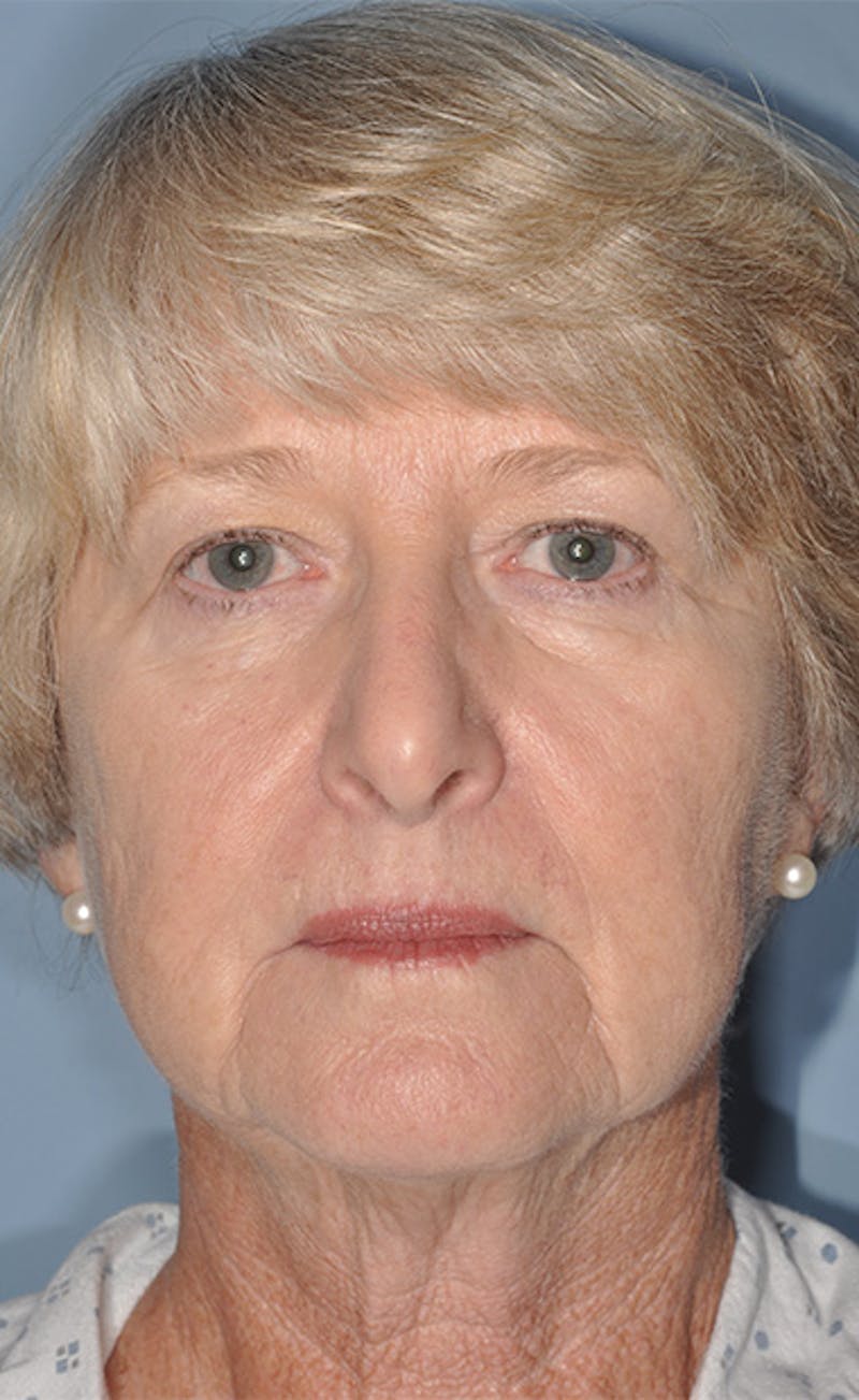 Facelift/Necklift Before & After Gallery - Patient 311543 - Image 1